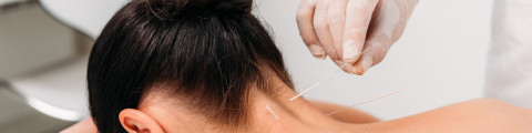 Femme en séance d'acupuncture avec des aiguilles dans le cou