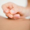 Naald acupunctuur in lichaam